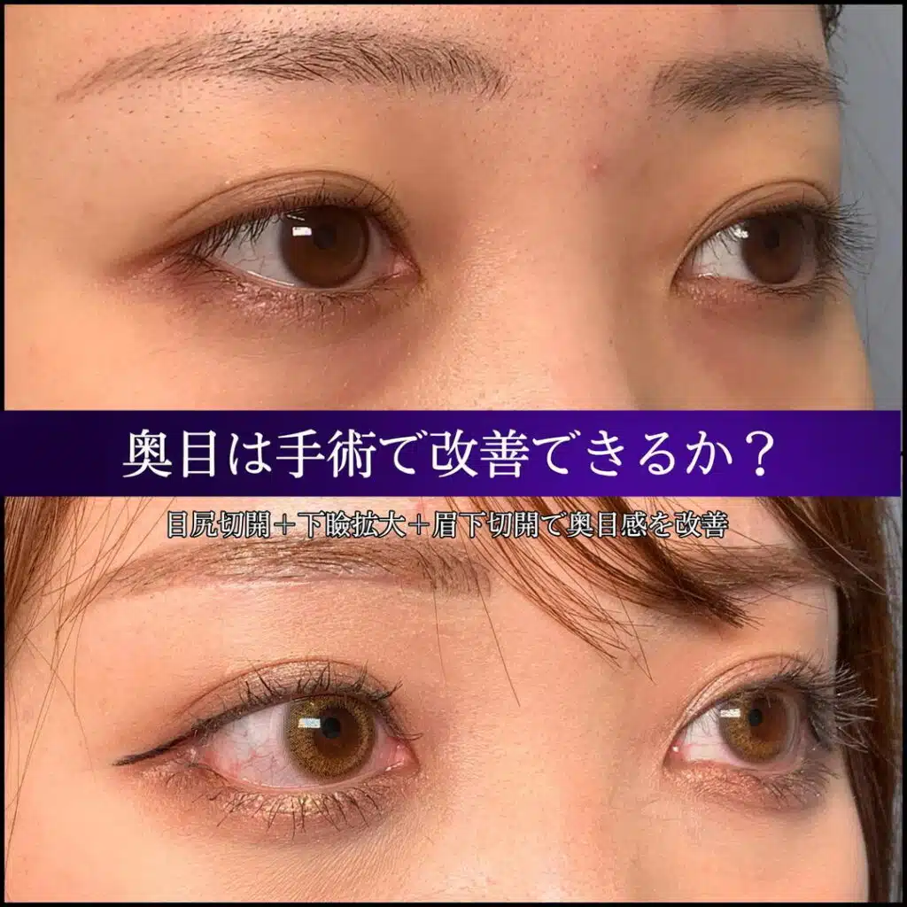 目尻切開　下瞼拡大　眉下切開　横浜みなとみらい