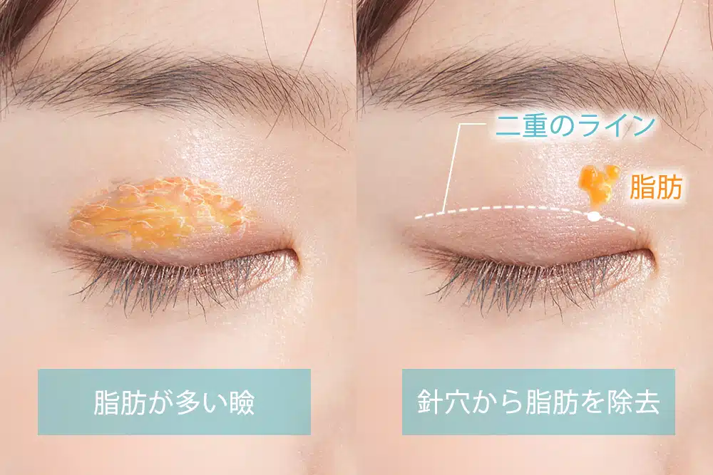まぶたの脂肪取り　横浜みなとみらい