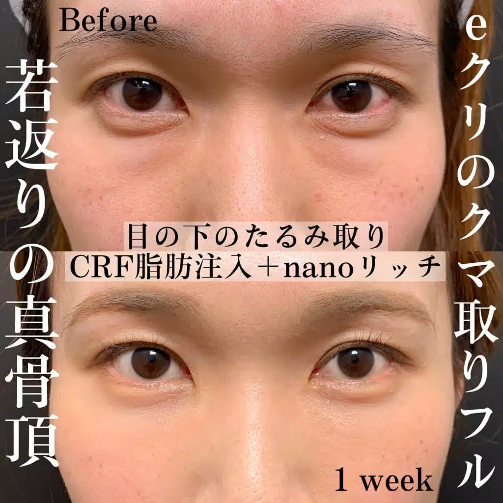 目の下のたるみ取り　CRF脂肪注入　nanoリッチ　横浜みなとみらい