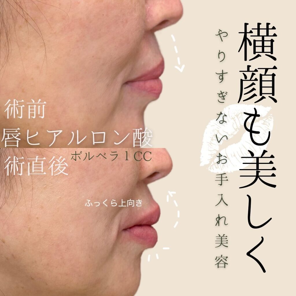 坂本医師の唇ヒアルロン酸の症例写真