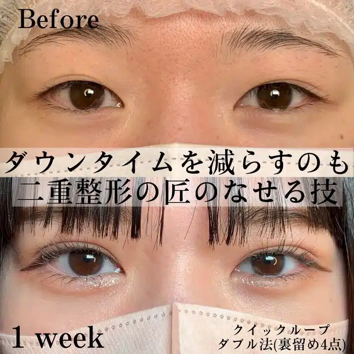 クイックループダブル法（裏留め4点）　横浜みなとみらい