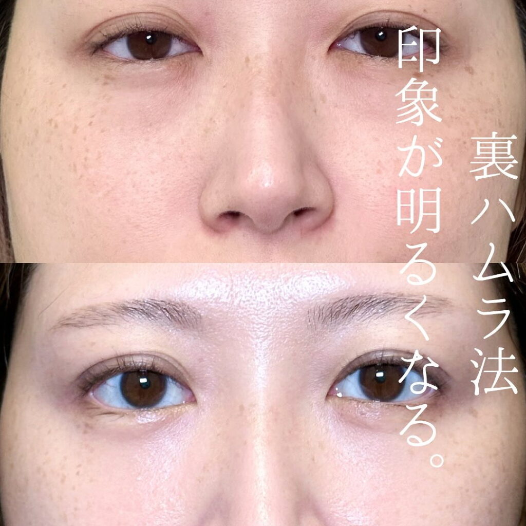 坂本医師の裏ハムラのクマ取りの症例写真