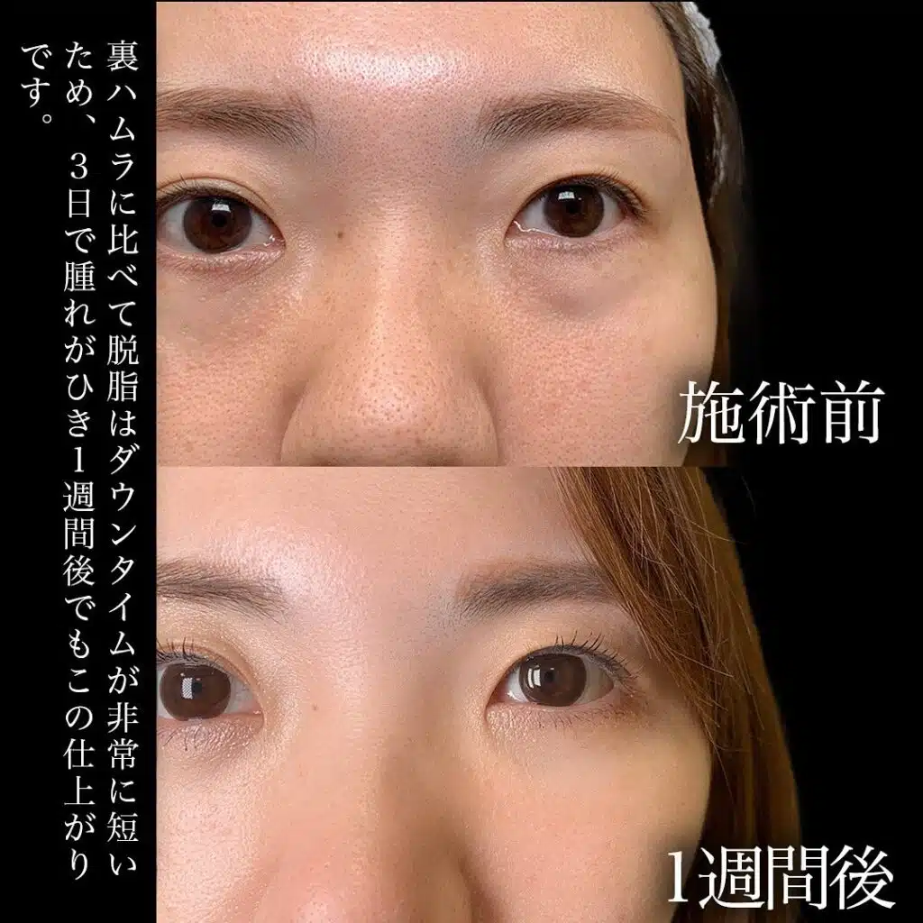 経結膜脱脂　横浜みなとみらい