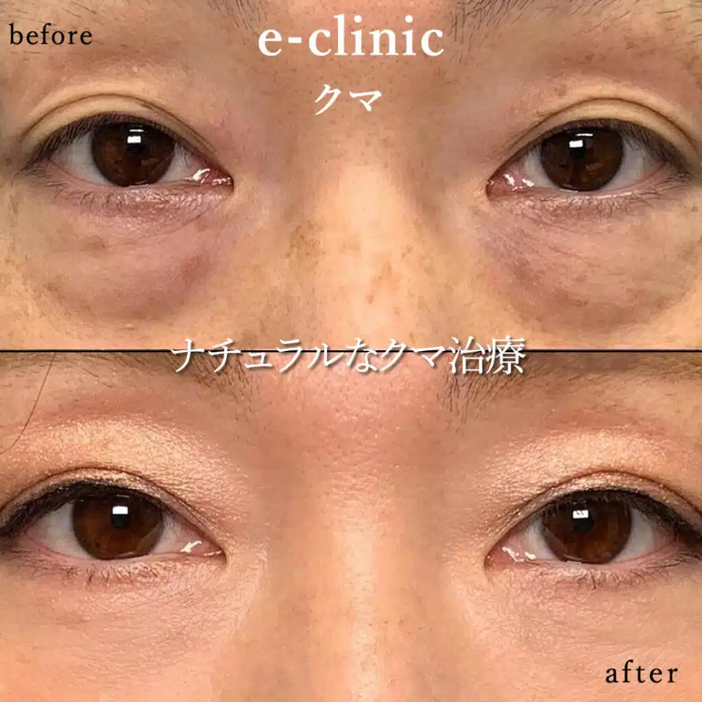 eclinic横浜みなとみらい院の表ハムラの症例画像(3)