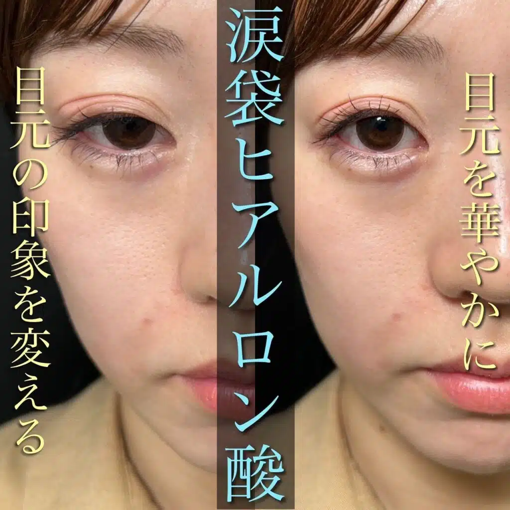 涙袋ヒアルロン酸　横浜みなとみらい