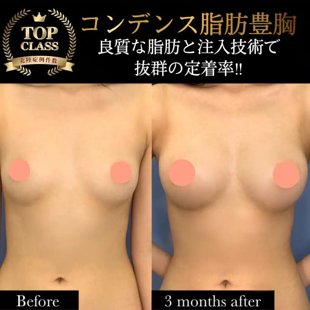 コンデンス脂肪豊胸　横浜みなとみらい
