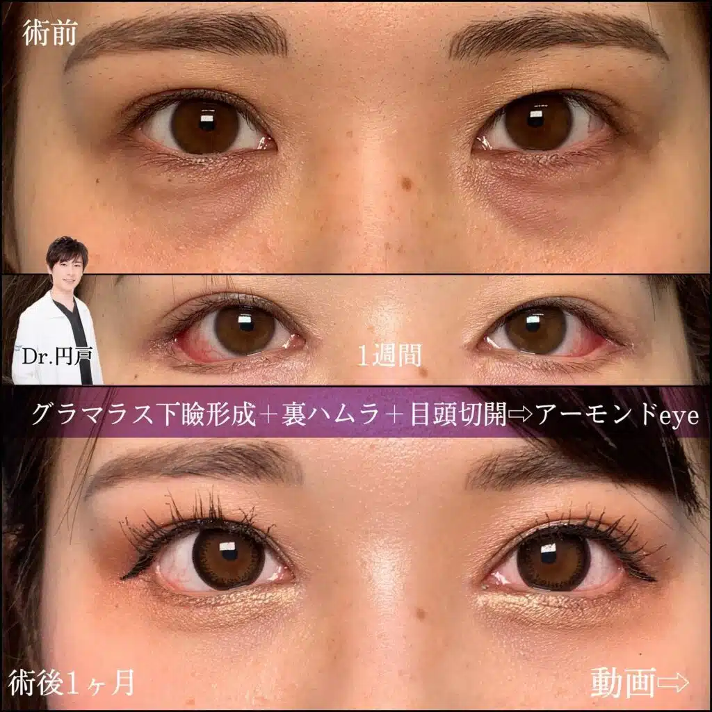 グラマラス下瞼形成　裏ハムラ　目頭切開　横浜みなとみらい