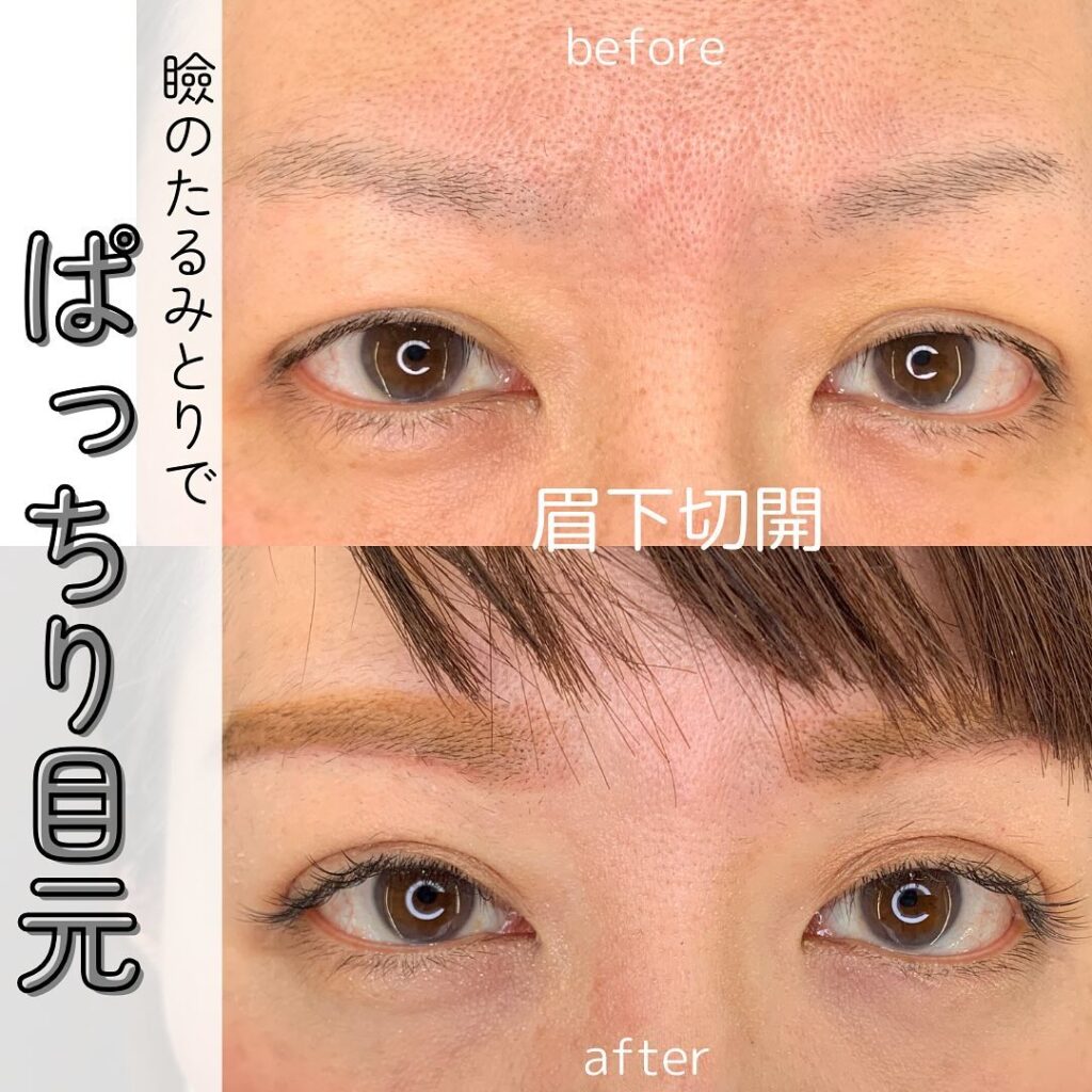 坂本医師の眉下切開の症例写真