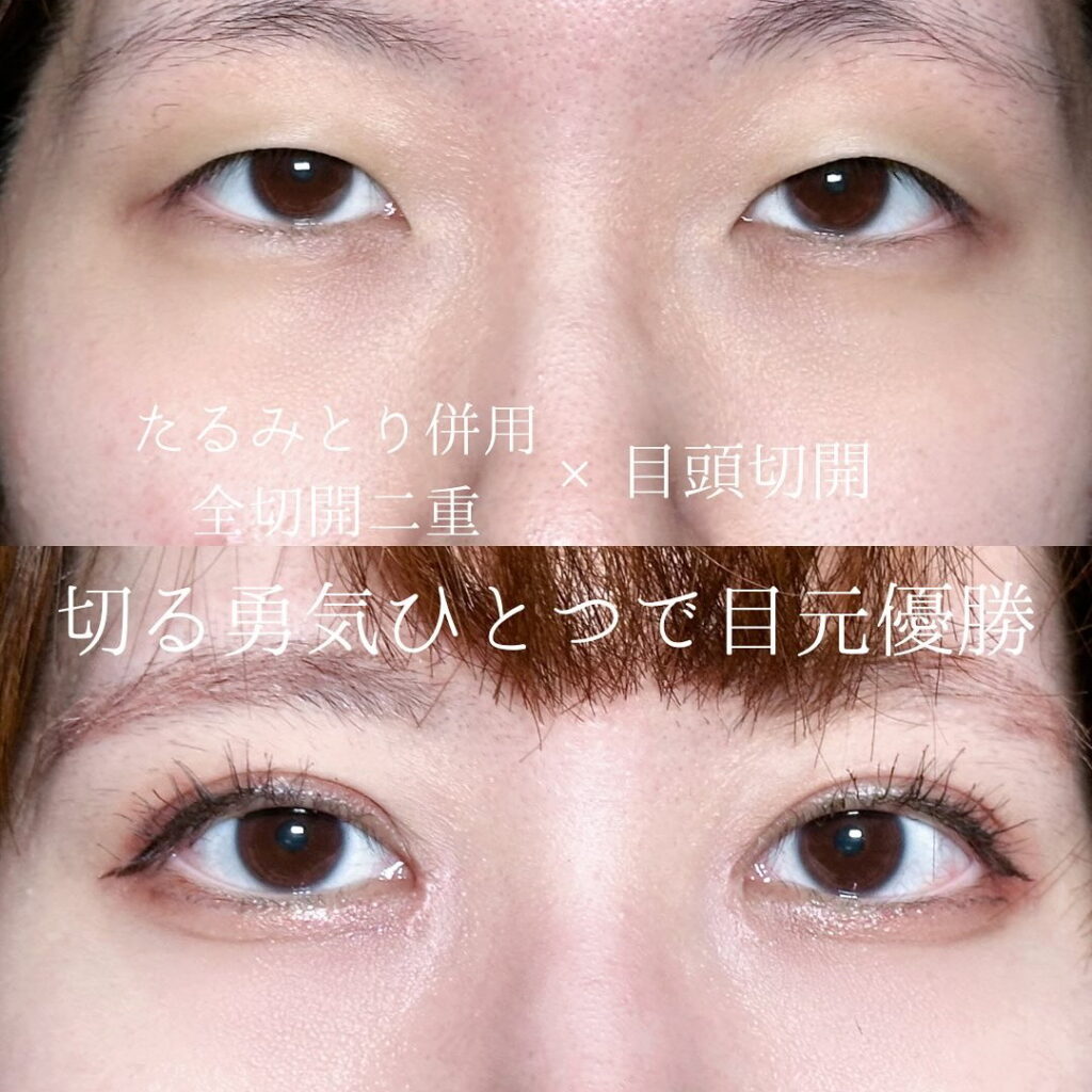 坂本医師のたるみとり併用全切開二重と目頭切開の症例写真