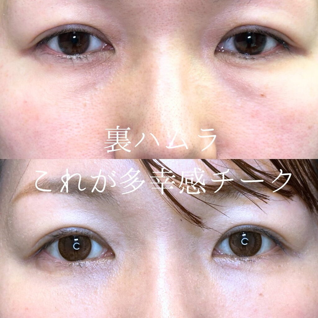 坂本医師の裏ハムラの症例写真