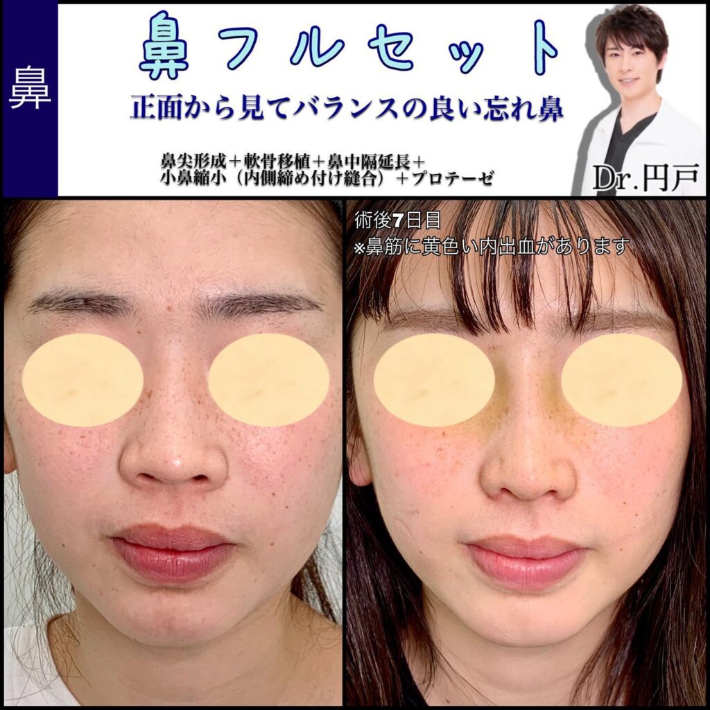 プロテーゼの症例