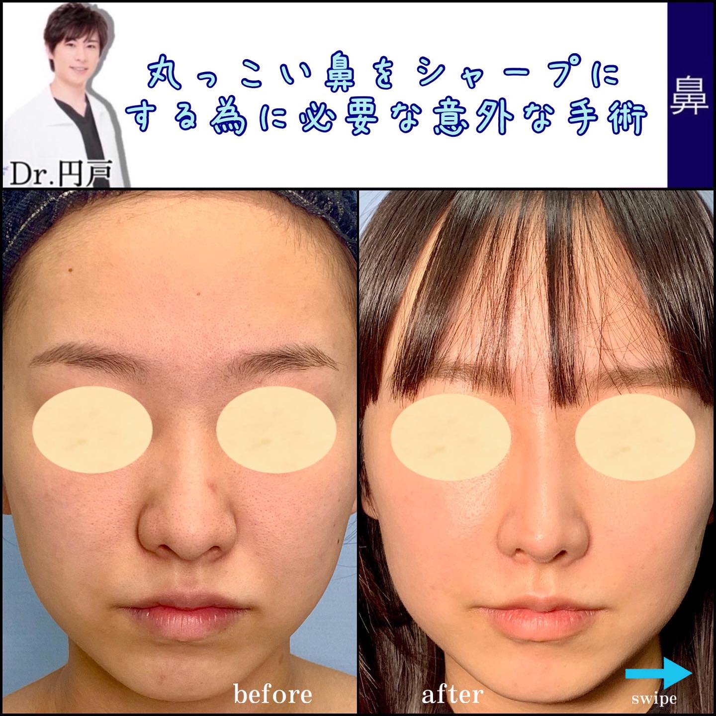 鼻尖形成と軟骨移植と鼻中隔延長の症例写真 (2)