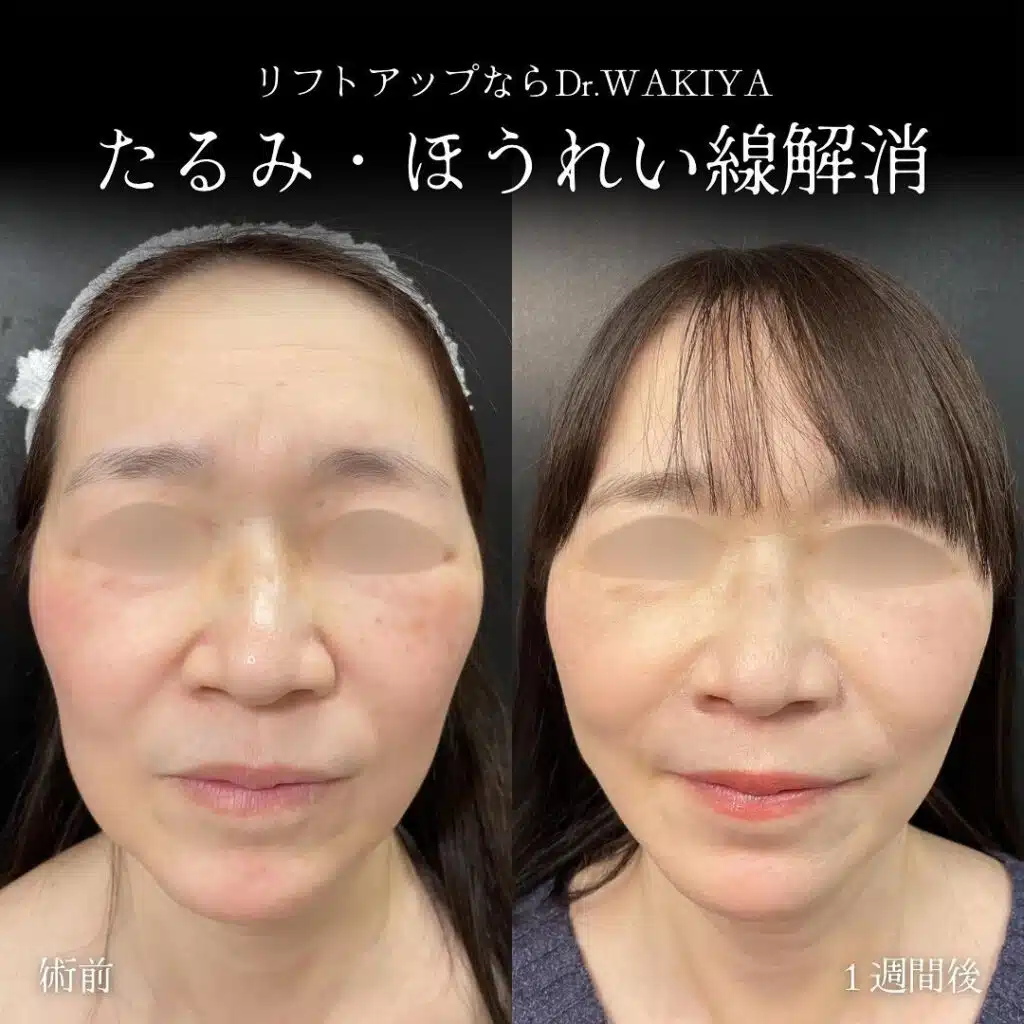 たるみ・ほうれい線解消 横浜みなとみらい