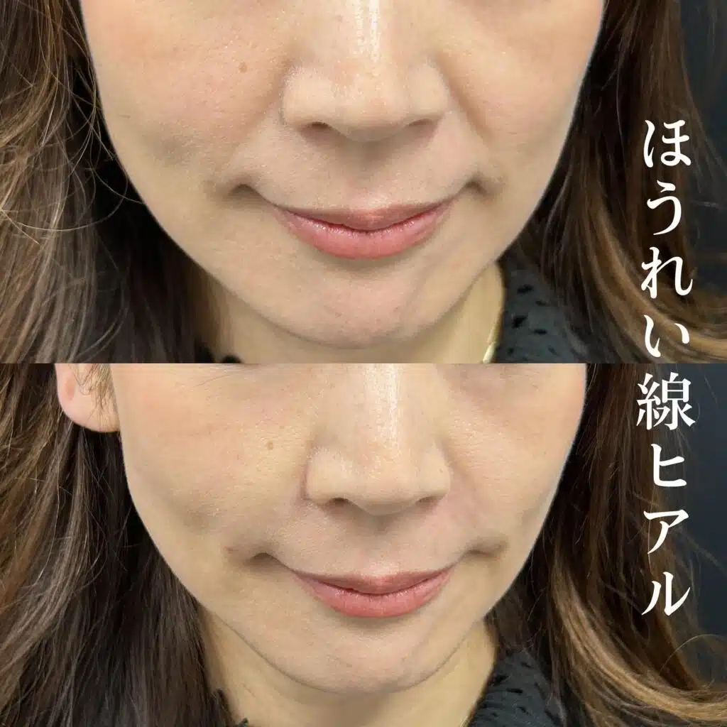 ほうれい線ヒアル 横浜みなとみらい