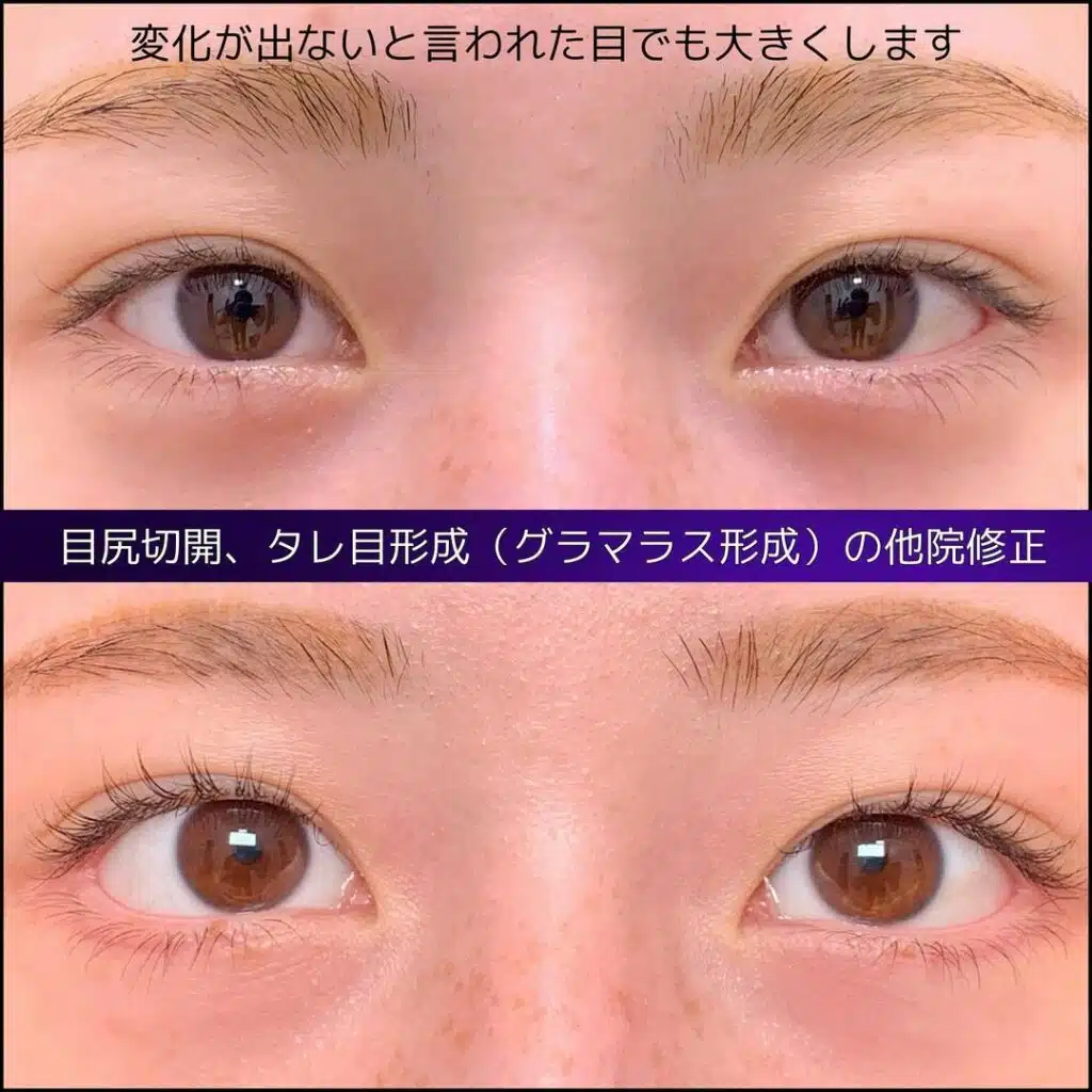 目尻切開　タレ目形成（グラマラス形成）　他院修正　横浜みなとみらい