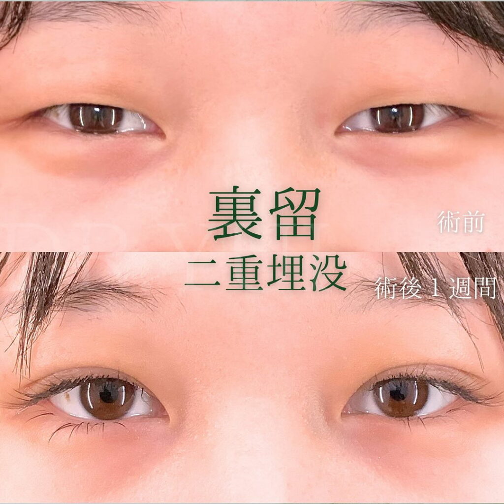 坂本医師の埋没法の症例写真