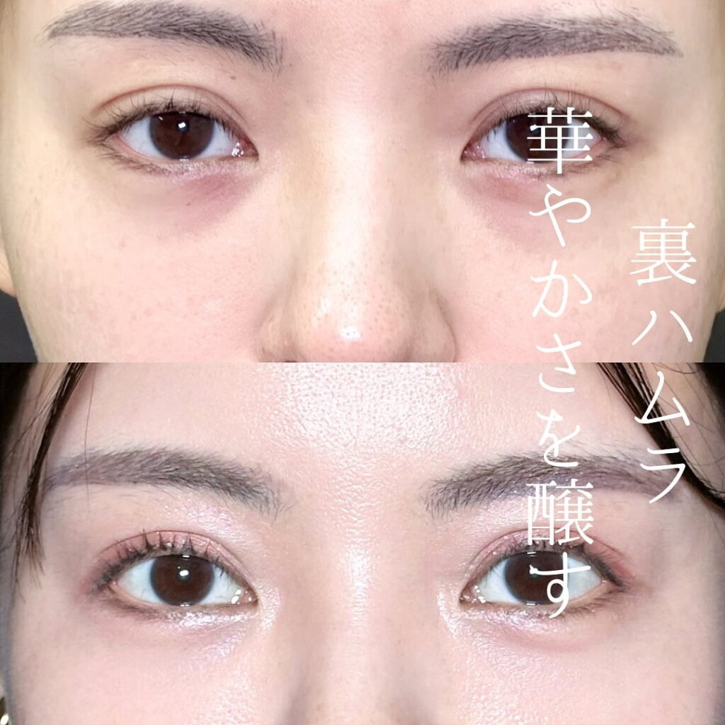 坂本医師の裏ハムラの目元の症例写真