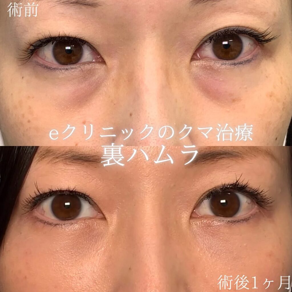 eクリニック横浜みあとみらい院の裏ハムラの症例画像（3）