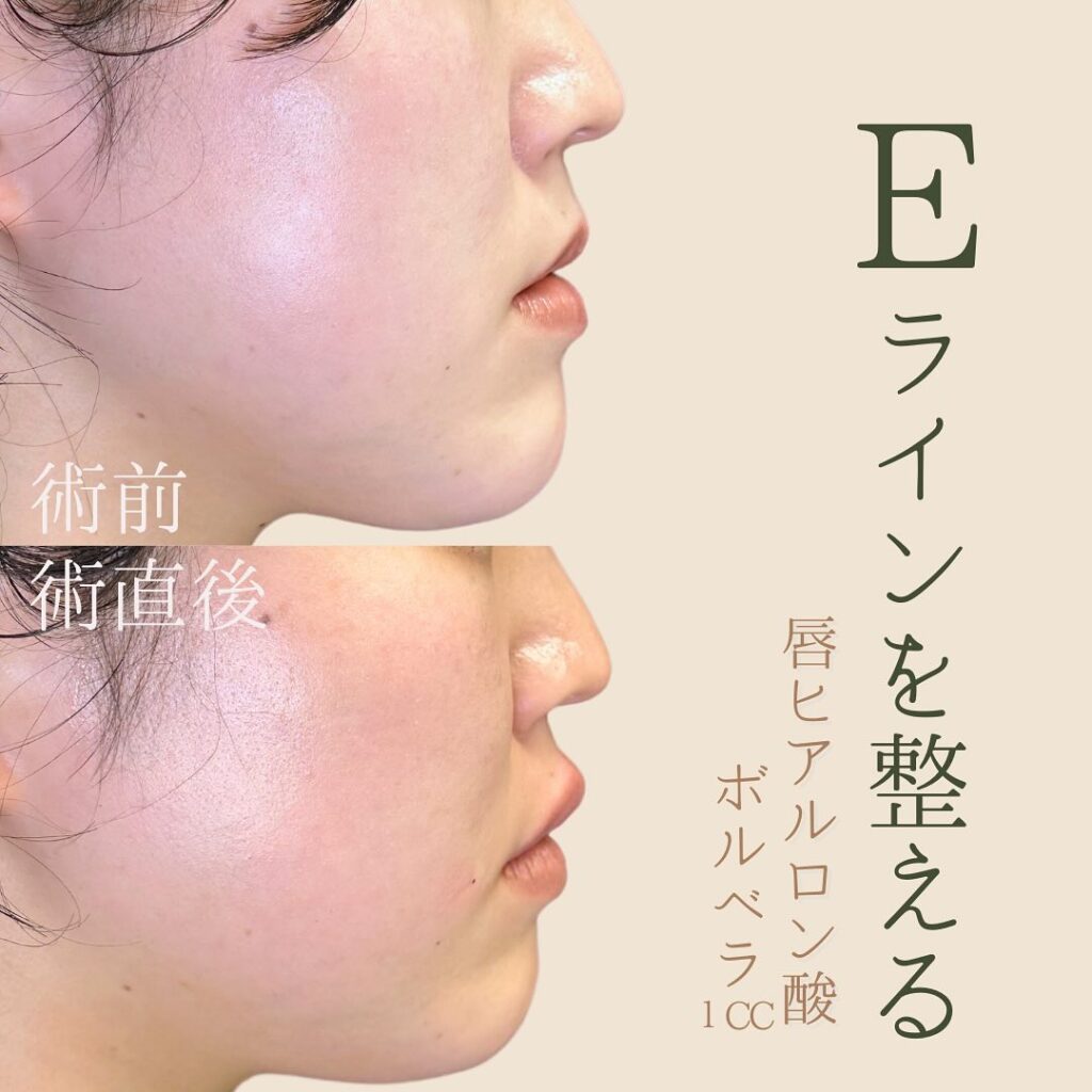 坂本医師の唇のヒアルロン酸の症例写真