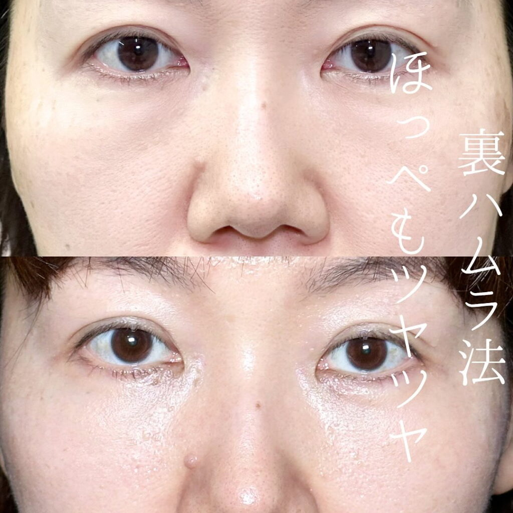 坂本医師の裏ハムラの女性の症例写真