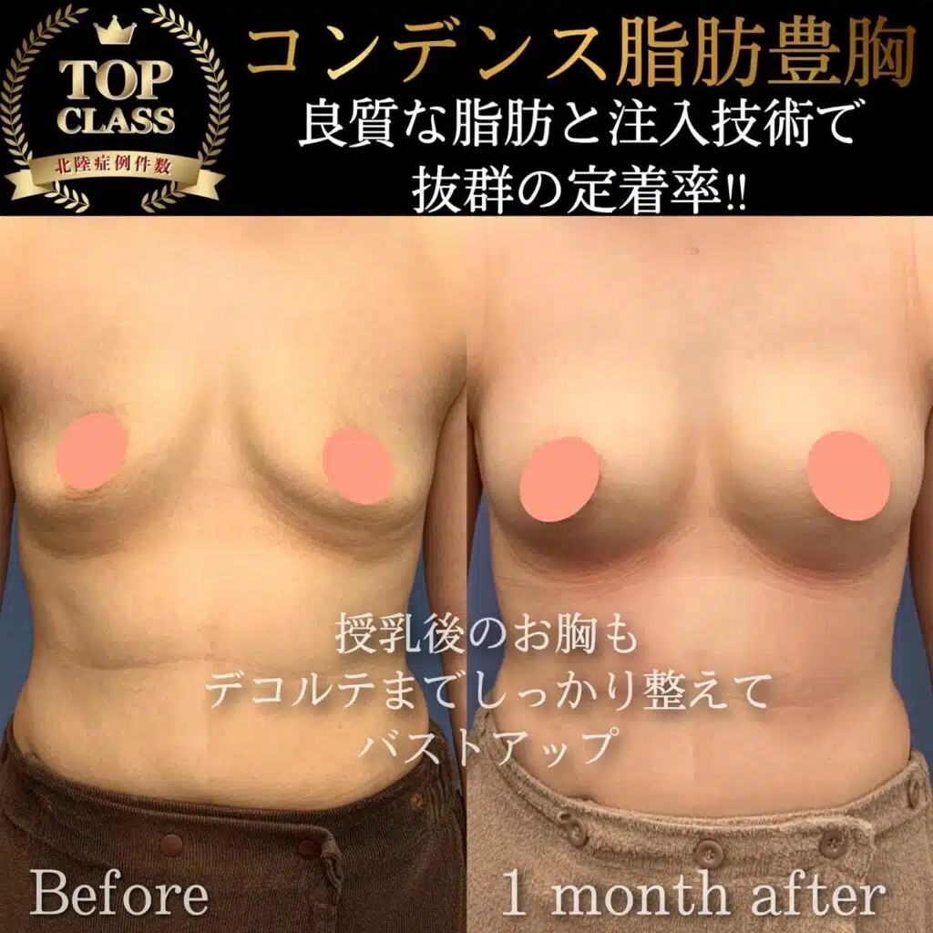 コンデンス脂肪豊胸　横浜みなとみらい