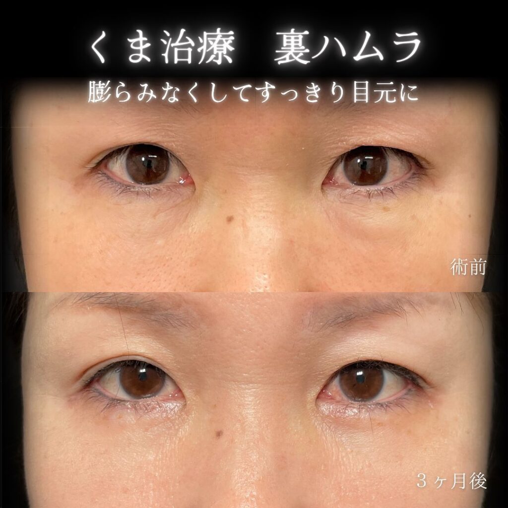 eクリニック横浜みあとみらい院の裏ハムラの症例画像（6）
