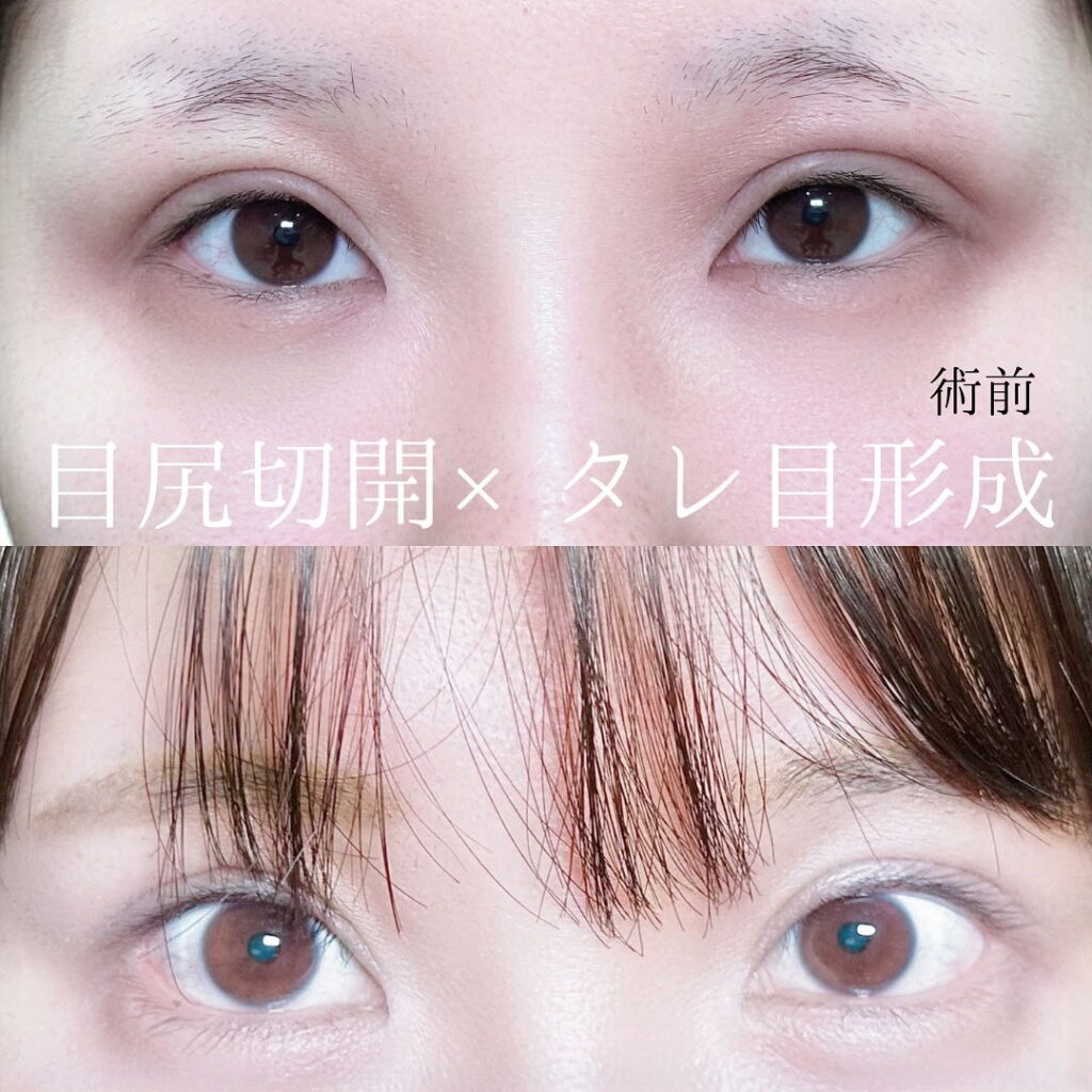 坂本医師の目尻切開とタレ目形成の症例写真
