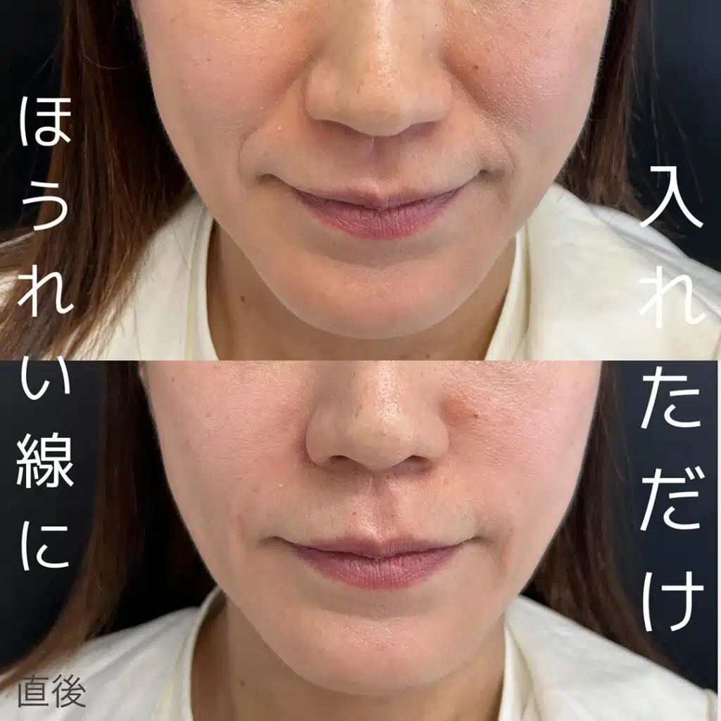 ほうれい線に入れただけ 横浜みなとみらい