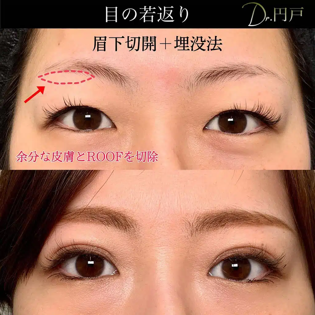 眉下切開　埋没法　横浜みなとみらい