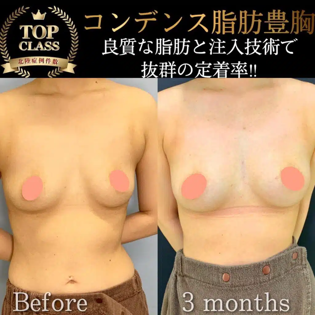 コンデンス豊胸　横浜みなとみらい