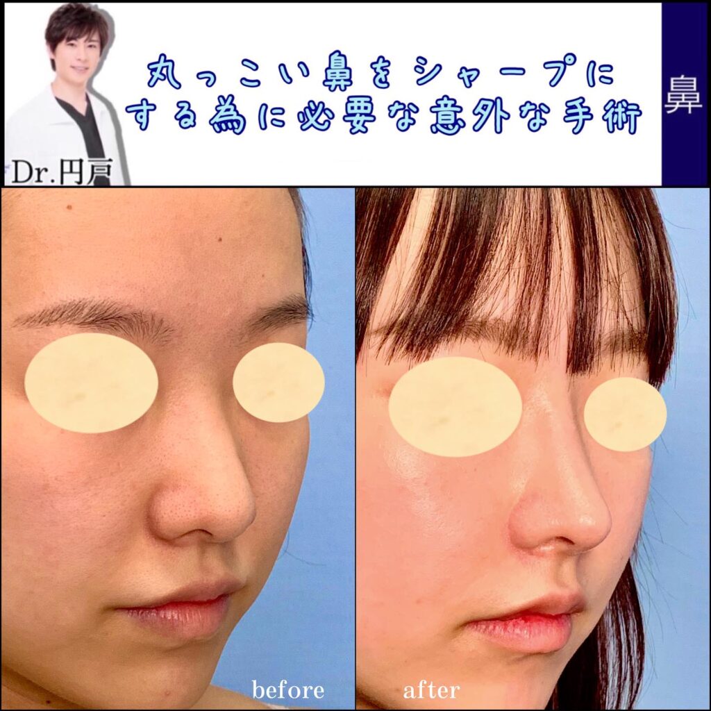 鼻尖形成と軟骨移植と鼻中隔延長の症例写真