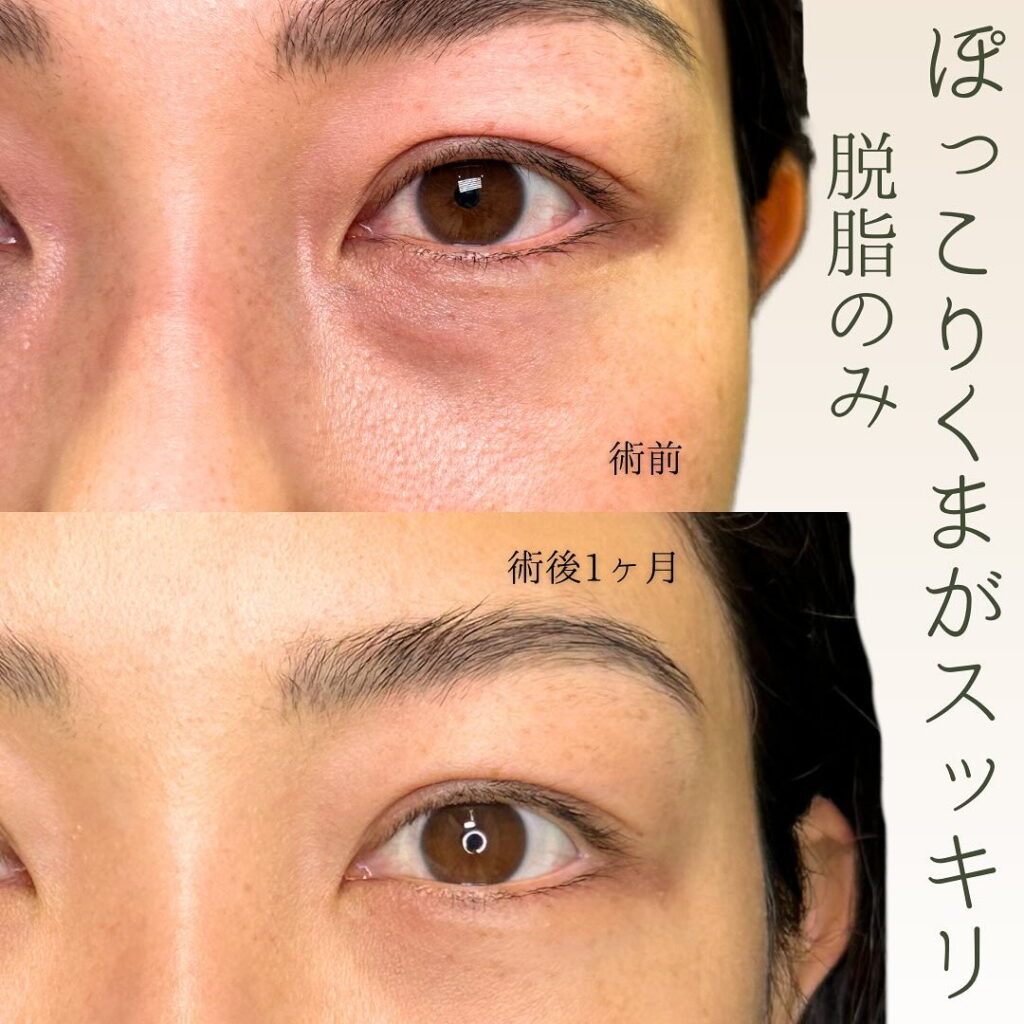坂本医師の経結膜脱脂の症例写真