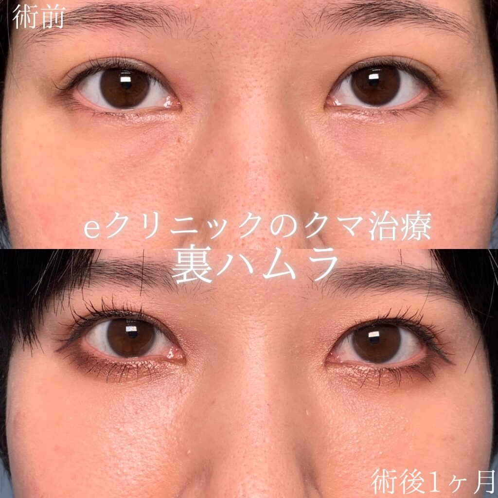 eクリニック横浜みあとみらい院の裏ハムラの症例画像（2）