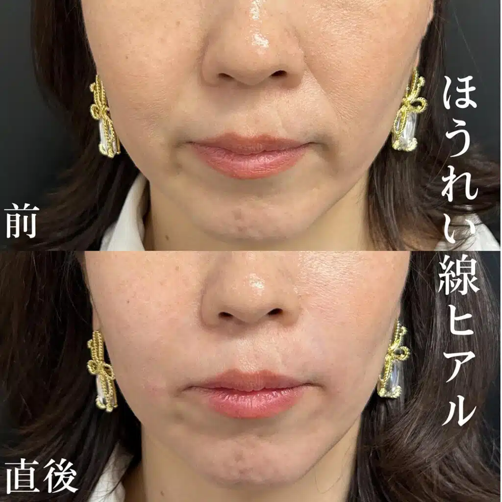 ほうれい線ヒアル 横浜みなとみらい