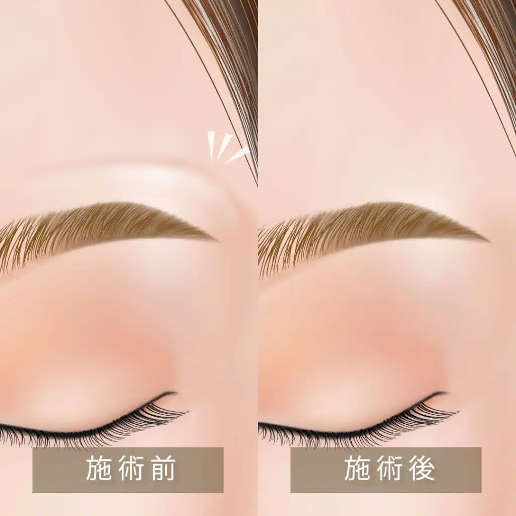 眉上ボトックス　横浜みなとみらい