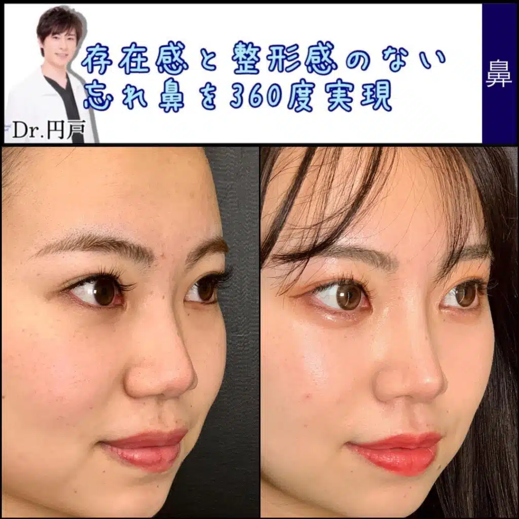 小鼻縮小　横浜みなとみらい