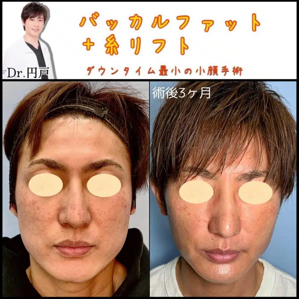 バッカルファット+糸リフト 横浜みなとみらい