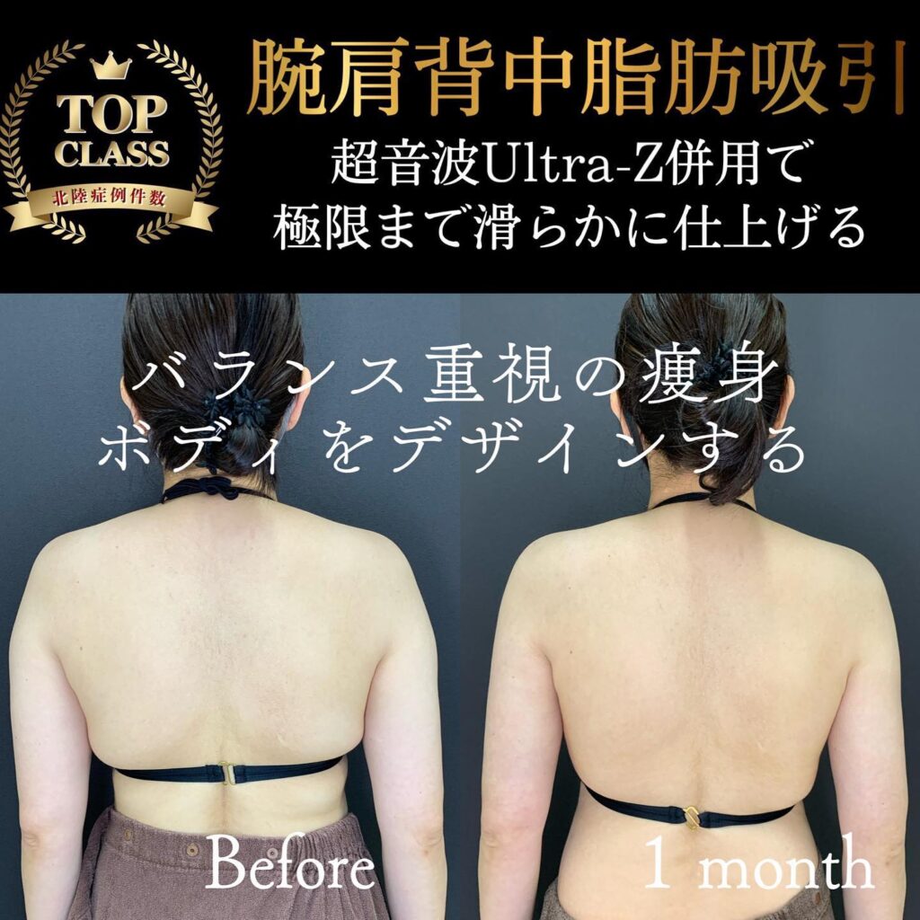 二の腕の脂肪吸引の症例写真 (9)