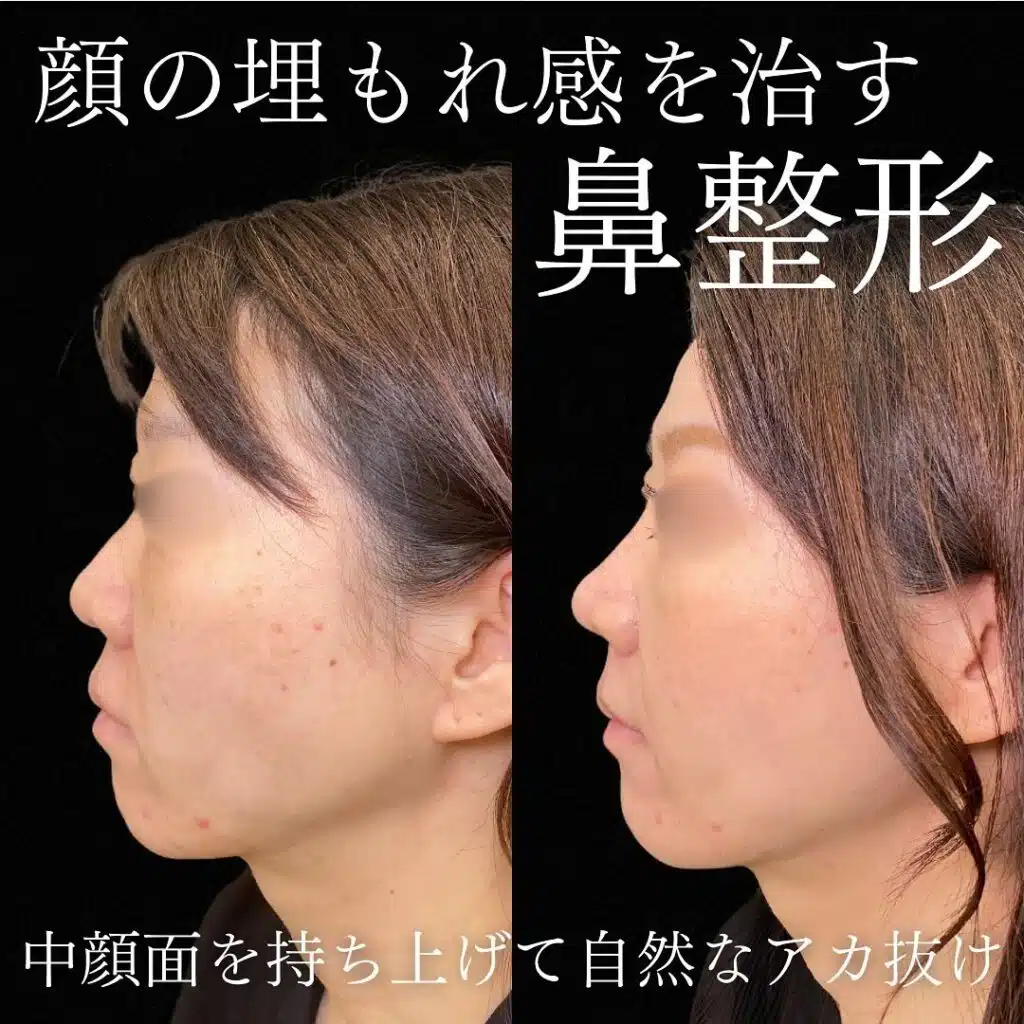 鼻尖形成クローズ法と耳軟骨移植と鼻プロテーゼと小鼻縮小と猫貴族と人工真皮と人中短縮術と糸リフトの症例写真 横浜みなとみらい