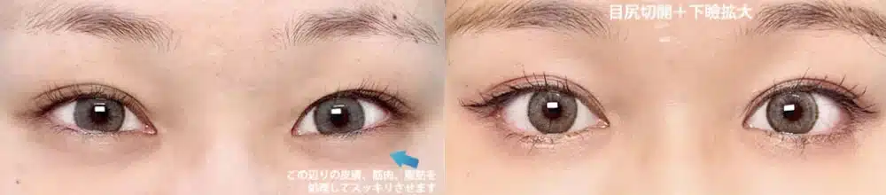 つり⽬を⾃然なアーモンド型に整えるデザイン 横浜みなとみらい
