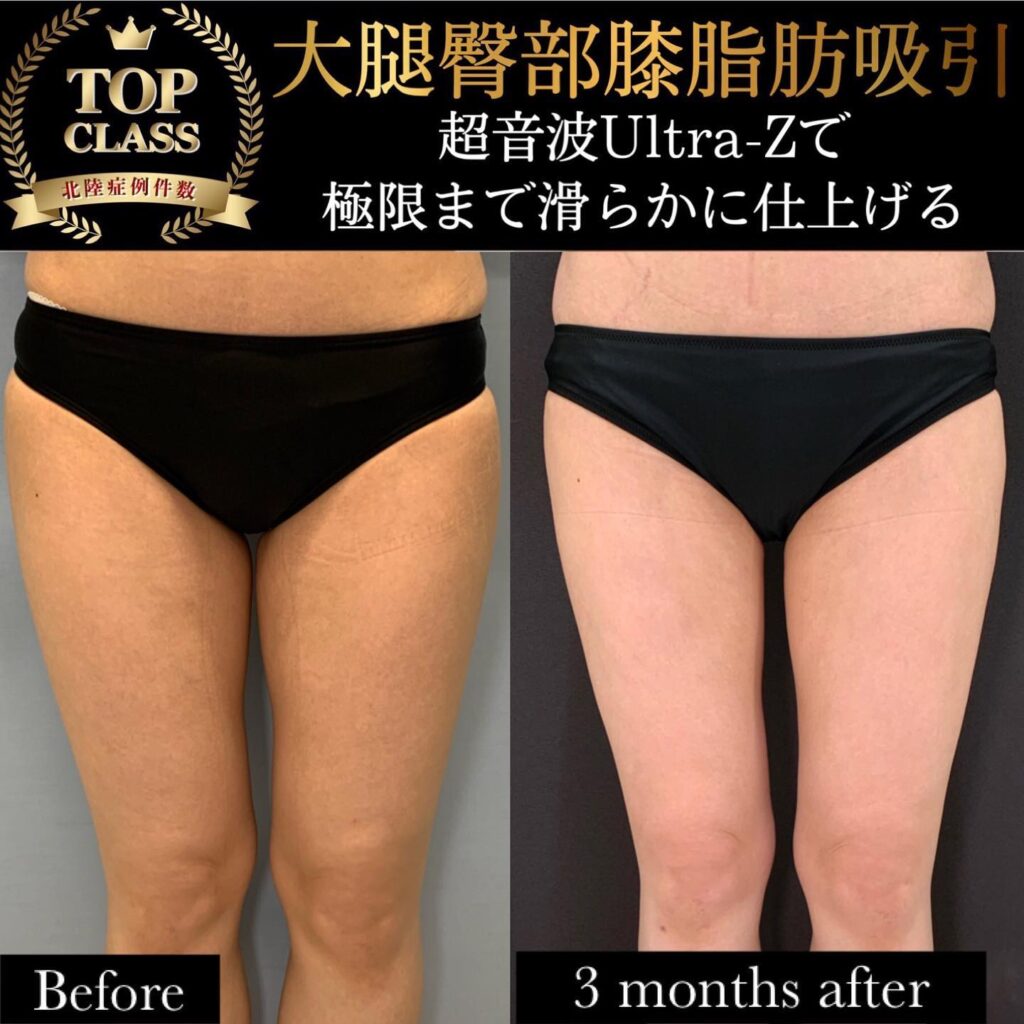 太ももの脂肪吸引の症例写真 (32)