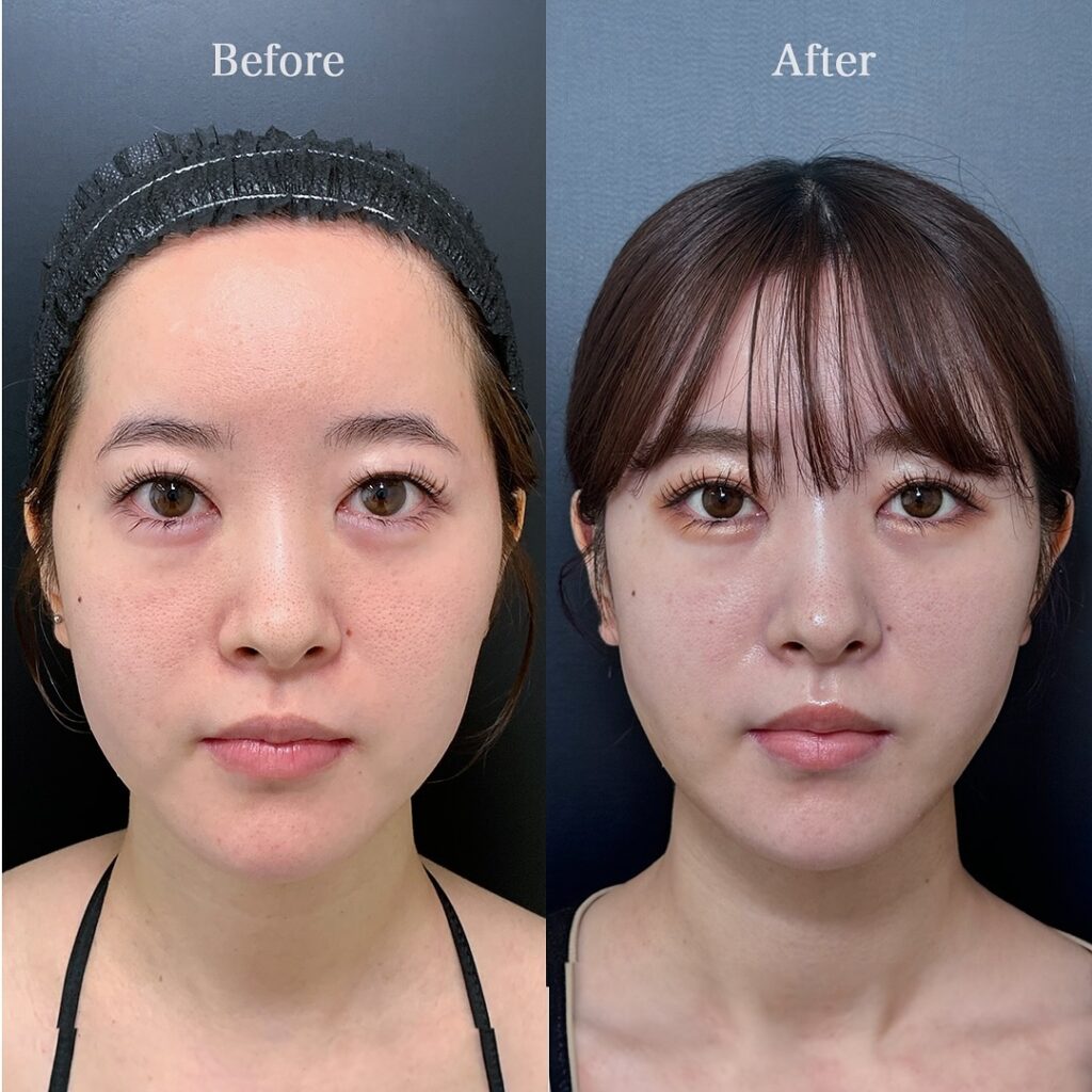 脂肪吸引と糸リフトの症例写真 (2)