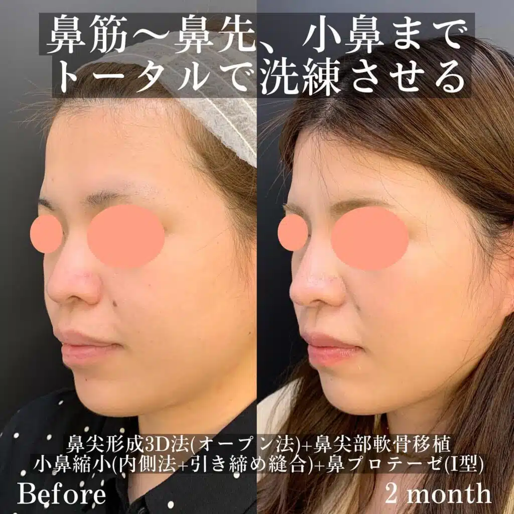 鼻尖形成3D法(オープン法)+鼻尖部軟骨移植+小鼻縮小(内側法+引き締め縫合)+鼻プロテーゼ(Ⅰ型) 横浜みなとみらい