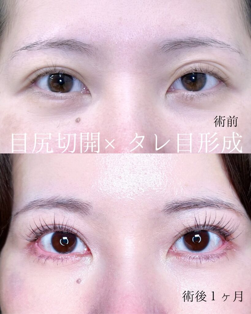 目尻切開とタレ目形成の症例写真