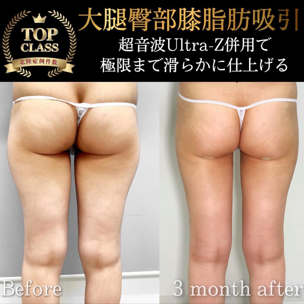 太ももの脂肪吸引の症例写真 (31)