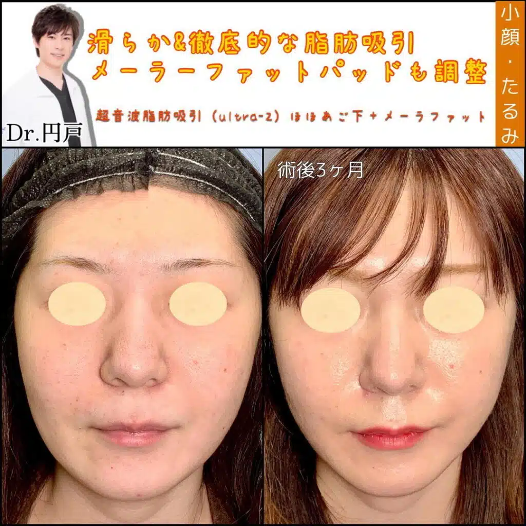 超音波脂肪吸引ほほあご下+メーラーファット 横浜みなとみらい