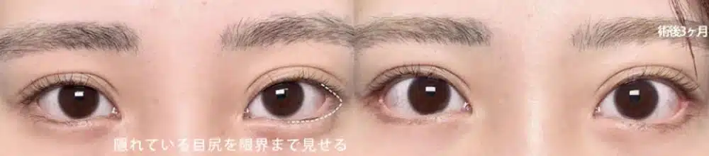 目尻側の白目の露出を増やすデザイン 横浜みなとみらい