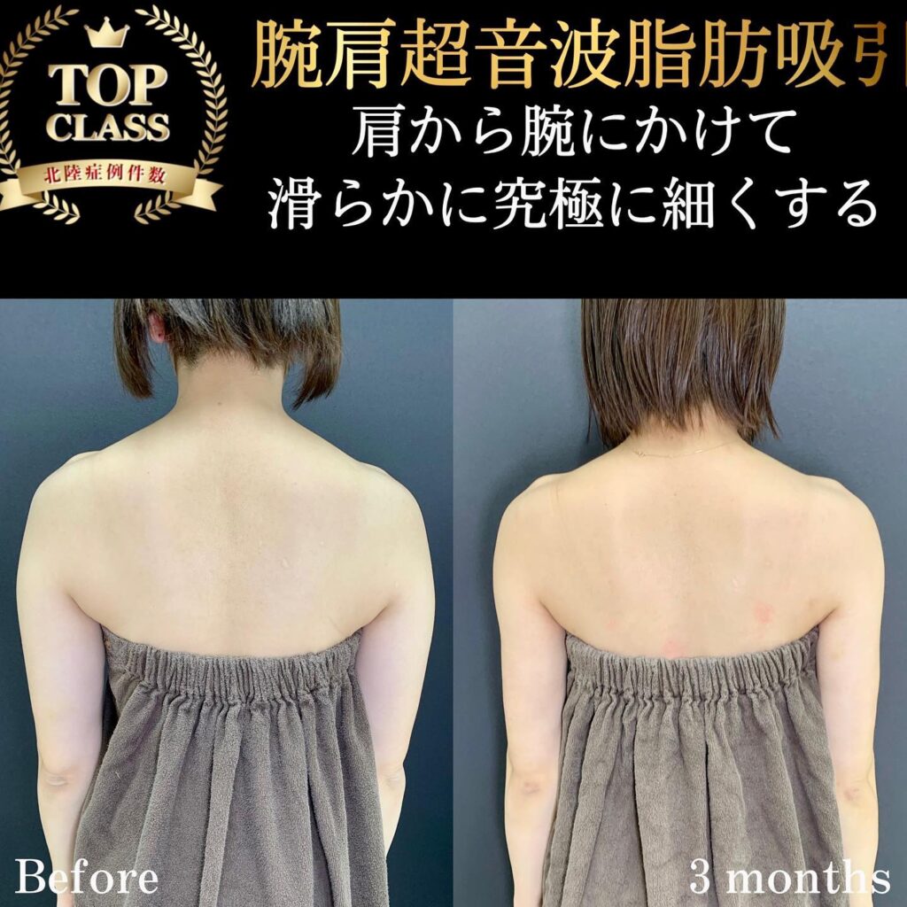 二の腕の脂肪吸引の症例写真 (15)