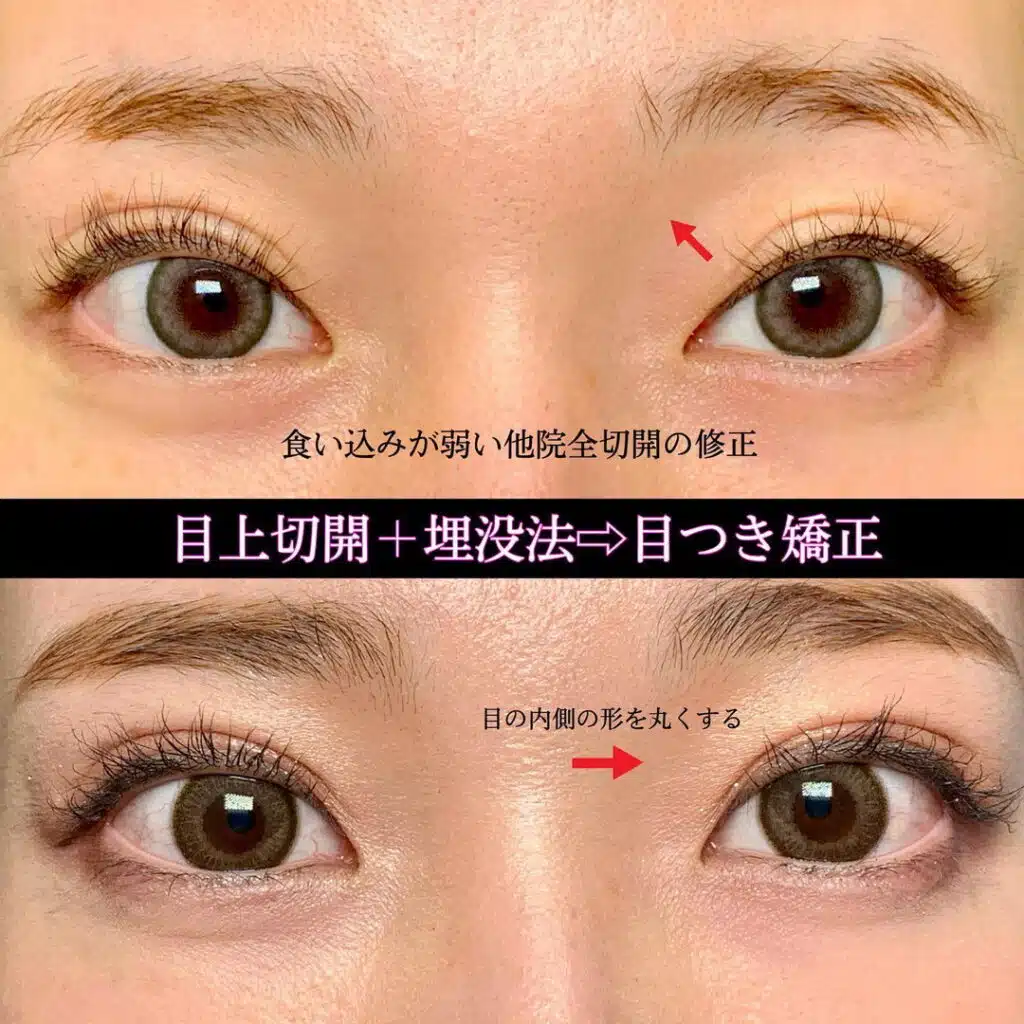 目上切開+埋没法　横浜みなとみらい
