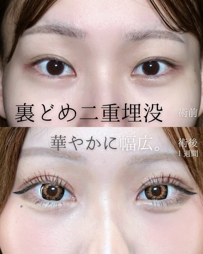 埋没法の症例写真 (11)